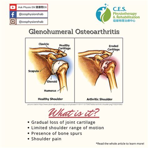 Glenohumeral Osteoarthritis: Literature Summary