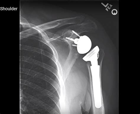 Reverse Total Shoulder Arthroplasty — OrthopaedicPrinciples.com