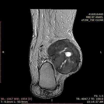 Spindle Cell Sarcoma