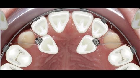 Orthodontic case report for palatally impacted canines traction - YouTube