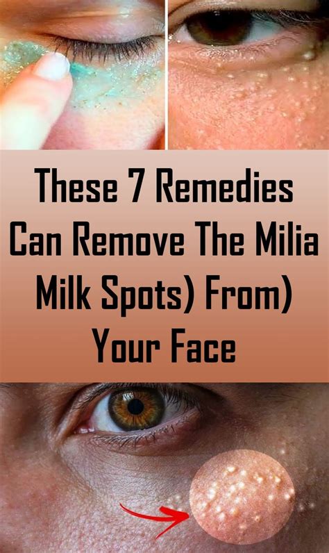 These 7 Remedies Can Remove The Milia (Milk Spots) From Your Face ...