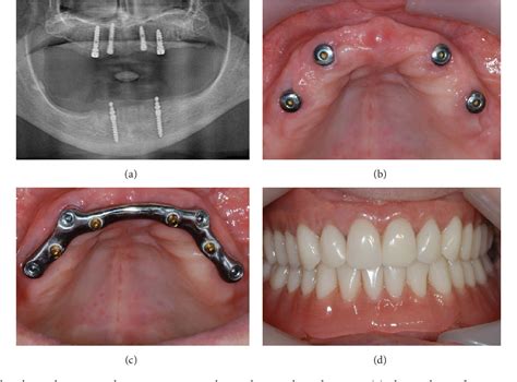 Figure 3 from Maxillary Overdentures Supported by Four Splinted Direct Metal Laser Sintering ...