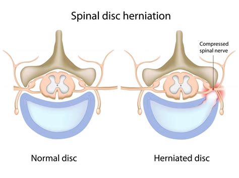 What is the Difference Between Disc Protrusion and Disc Extrusion?