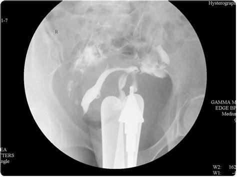 Indications and Contraindications for Hysterosalpingography