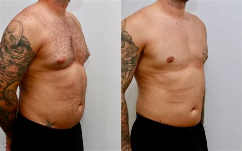 Gynecomastia Surgery