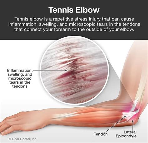 Tennis Elbow Chiropractor In St Augustine, FL | Derek Sisak, DC