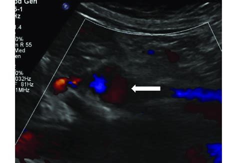 Duplex ultrasound scan depicting recanalized splenic artery aneurysm... | Download Scientific ...