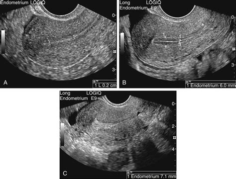 Abnormal Uterine Bleeding | Radiology Key