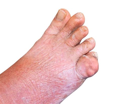 Gout Treatment & Symptoms Podiatrist near me- Beaver Valley Foot Clinic