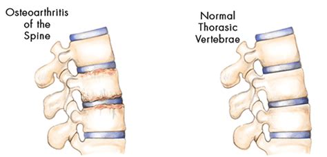 Spondylosis Causes | Bonati Spine Institute