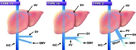 Different types of CEPS. Complete portosystemic shunts that do not ...