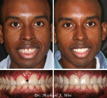 Teeth Veneers Before And After