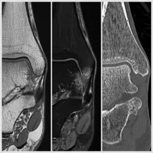 IMAGING GUIDED EUFLEXXA INJECTION FOR MANAGEMENT OF KNEE OSTEOARTHRITIS ...