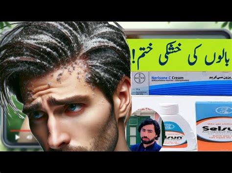 Seborrhoea disease | causes | symptoms | treatment | Urdu | hindi | Rashid medical tips - YouTube