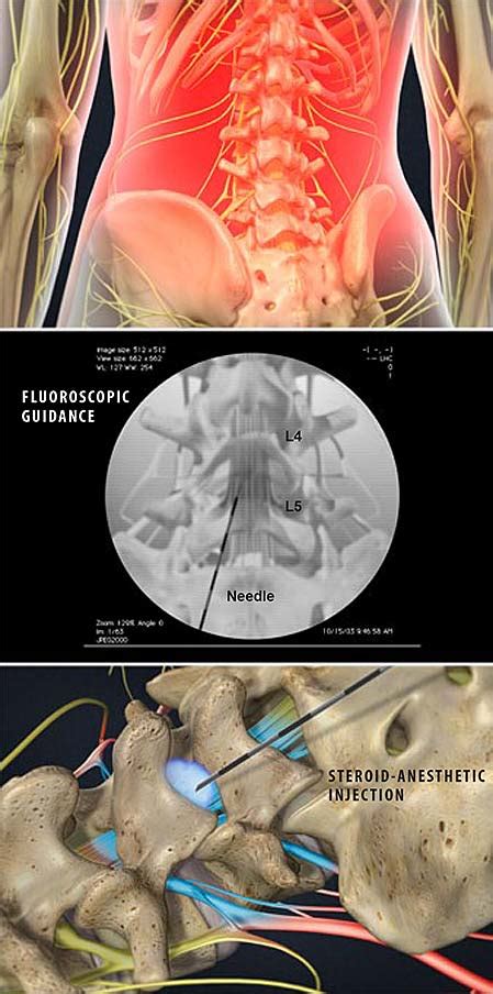 Lumbar Epidural Steroid Injection | Central Coast Orthopedic Medical Group