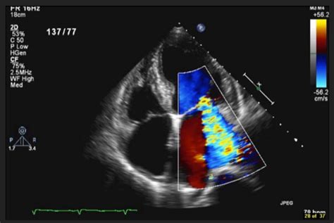 Echocardiography - Orlando Heart & Vascular Institute