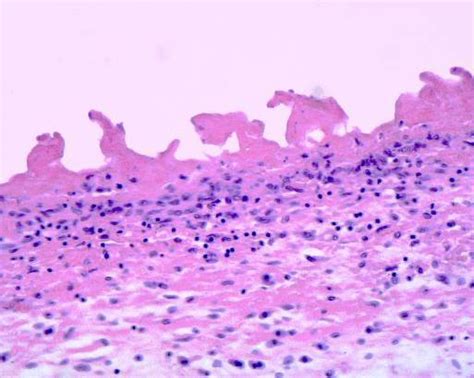 Pericarditis pathology - wikidoc