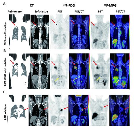 Tracer Shows Which Lung Cancer Patients May B | EurekAlert!