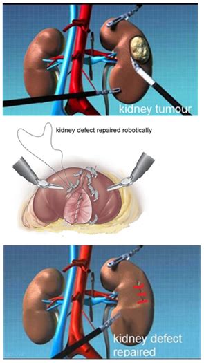 Robotic Partial Nephrectomy - Chin Chong Min Urology & Robotic Surgery Centre