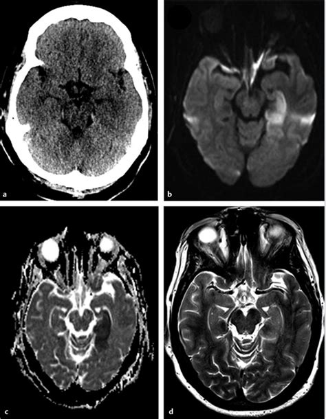 Diffusion Weighted Imaging in Vascular Pathology | Radiology Key