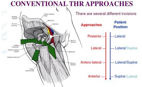 Joint Orthopaedic Centre | Direct Anterior Approach