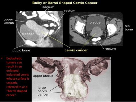 Cervical Cancer