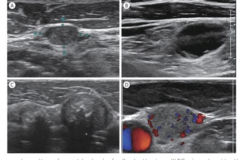 [PDF] Ultrasonographic Findings of Cervical Lymph Nodes | Semantic Scholar