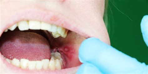 What Causes Canker Sores: 7 Reasons You Might Get Them Often