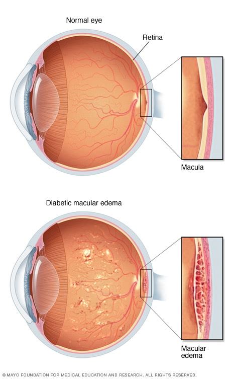 Diabetic macular edema - Mayo Clinic