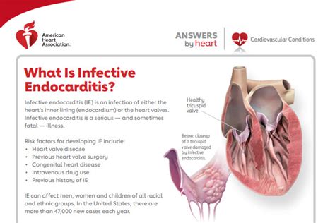 Can A Tooth Infection Lead To Endocarditis: Unraveling The Connection