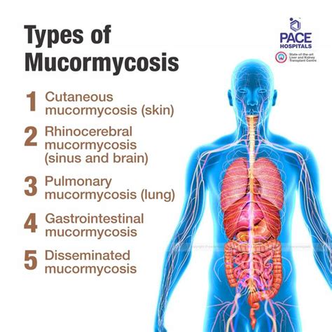 Pulmonary Mucormycosis