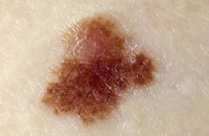 What Does Precancerous or Atypical Mole Mean? » Scary Symptoms