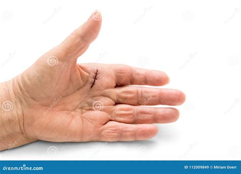 Hand Surgery of a Dupuytren`s Disease, Contracture or a Trigger Stock ...