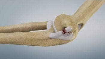 UCL (Tommy John Ligament) Tear Cincinnati | UCL Reconstruction Surgery Dayton, OH