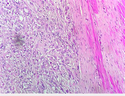 Microphotograph showing epithelioid cells with marked anisokaryosis and... | Download Scientific ...