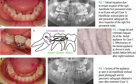 Figure 1 from Treatment of ectopic eruption of permanent mandibular first molars with innovative ...