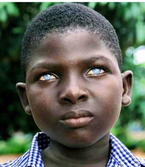 Boy with ocular albinism : r/interestingasfuck