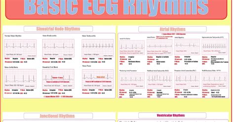 ECG Educator Blog : Basic ecg rhythm strips