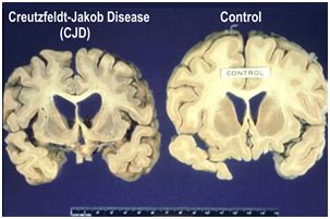 Creutzfeldt-Jakob Disease Causes, Symptoms, Diagnosis and Treatment ...