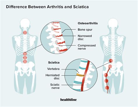 Arthritis and Sciatica: How They Differ, Causes, Symptoms, More ...