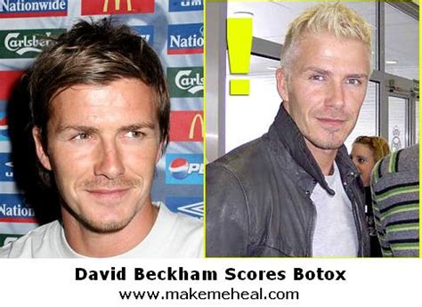 David Beckham Plastic Surgery Before and After Nose Job and Lips Augmentation ~ Celebrity Before ...