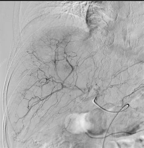 Liver cancer treatment, CT scan - Stock Image - F037/7180 - Science Photo Library