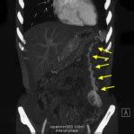 Hemangiopericytoma of the Greater Omentum - Journal of Gastrointestinal Surgery