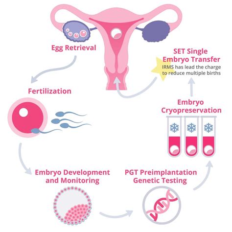 The stages of in vitro fertilization (IVF) - Healthy Food Near Me