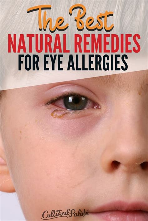 Natural Remedies for Eye Allergies - Cultured Palate