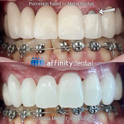 Zirconia Dental Bridge | Affinity Dental Clinics