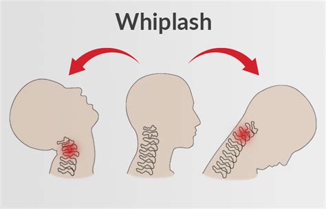 Whiplash - pt Health