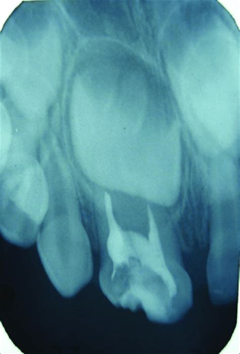 Intraoral periapical radiograph showing treatment performed in the... | Download Scientific Diagram