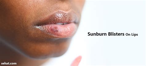 Sunburn Blisters On Lips- Causes And Tips To Get Rid