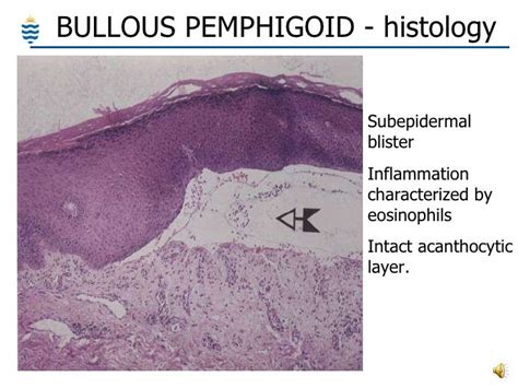 acantholysis - pictures, photos